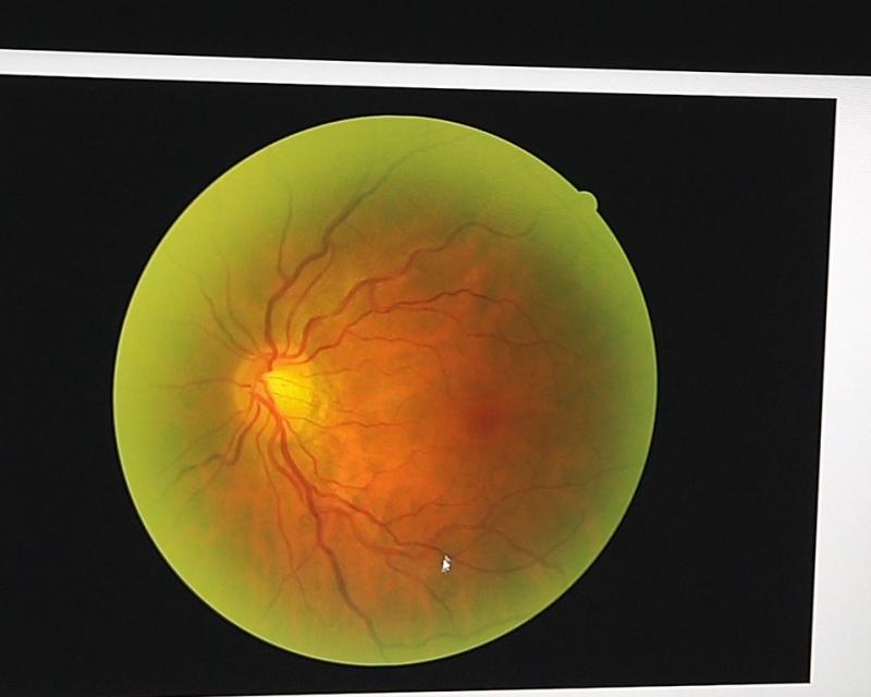 Bassanonet.it Occhio al diabete